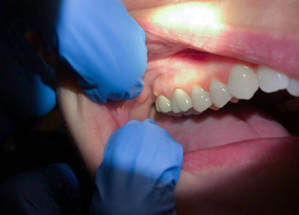 Best Emergency Treatment for Dental Infections or Abscesses in Bloomingburg, OH