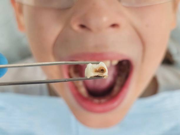 Best Emergency Treatment for Dental Infections or Abscesses in Bloomingburg, OH